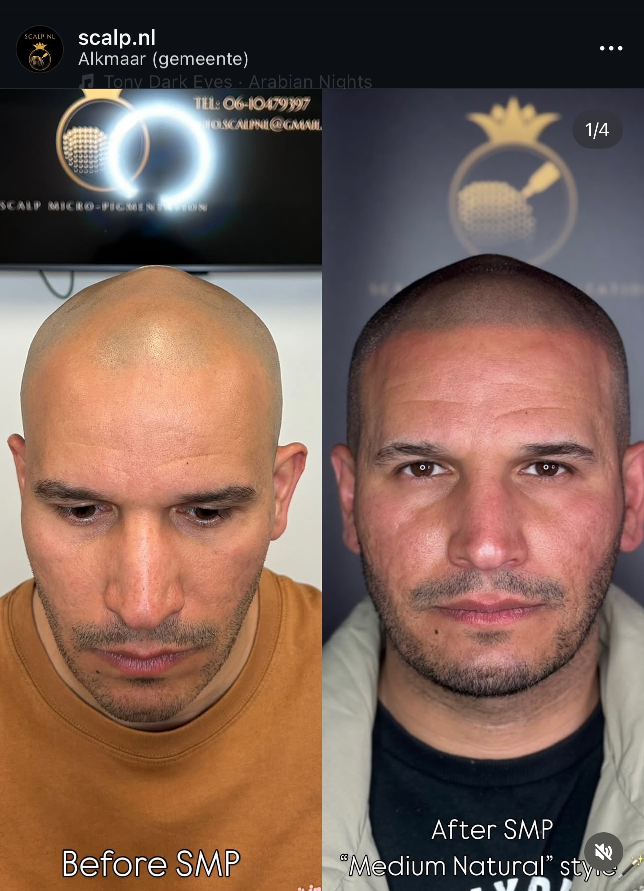MHP shaven look resultaat – Scalpnl.nl Alkmaar